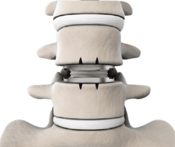 Artificial Spine Lumbar Disc Replacement