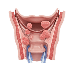Arytenoidectomy