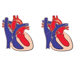 Atrial Septal Defect Closure-ASD