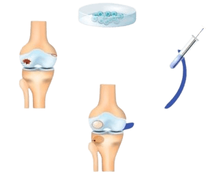 Autolog Xondrotsitlarni Implantatsiya Qilish