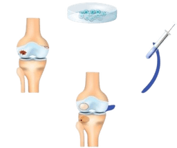Autologous Chondrocyte Implantation