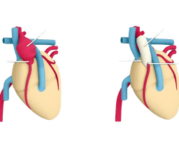 Bentall Procedure