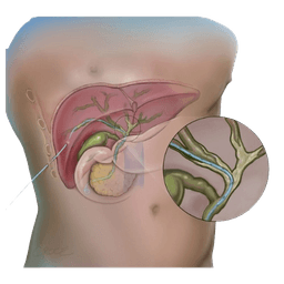 Biliary Drainage & Stenting Surgery