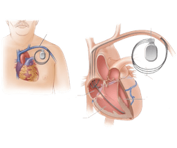 Biventricular Pacing