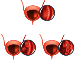 Bladder Cancer