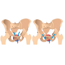 Bladder Slings (TOT & TVT Slings)