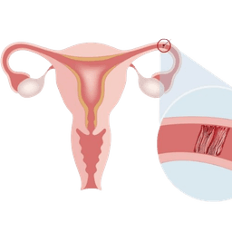 Blocked Fallopian Tube