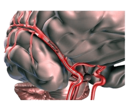 Blood Clot Brain Surgery