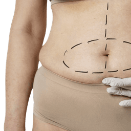 Body Lift Surgery (Lower/Total Body Lift)