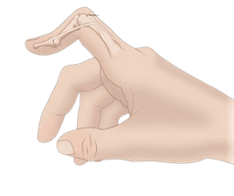 Boutonniere Deformity