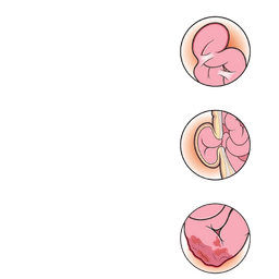 Bowel Obstruction