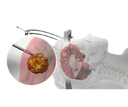 Brain Biopsy