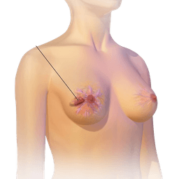 Breast Cancer Surgery