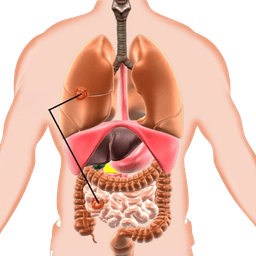 Carcinoid Tumors