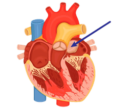 Cardiac Tumor