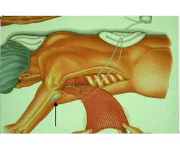 Cardiomyoplasty