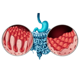 Celiac Disease