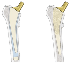 Cemented Total Hip Replacement