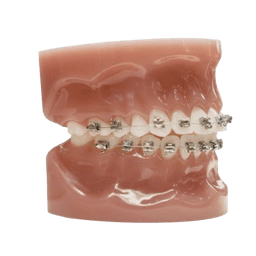 Ceramic Braces