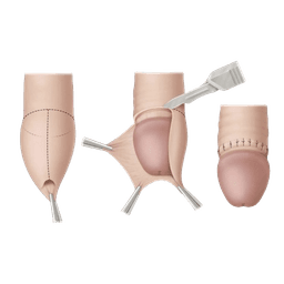 Circumcision