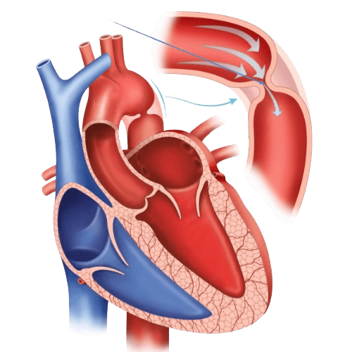 Aorta coarktatsiyasi jarrohligi - CoA