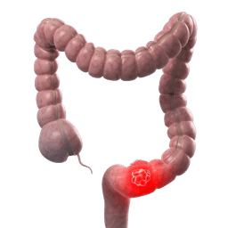 Colon Cancer