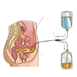 Continuous Ambulatory Peritoneal Dialysis (CAPD)