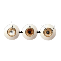Corneal Transplantation - Eye Transplant