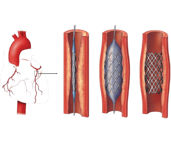 Koronar angioplastika