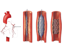Coronary Angioplasty