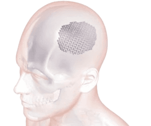 Kranialoplastika