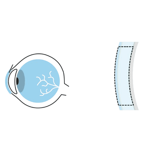Chuqur old lamellar keratoplastika - DALK