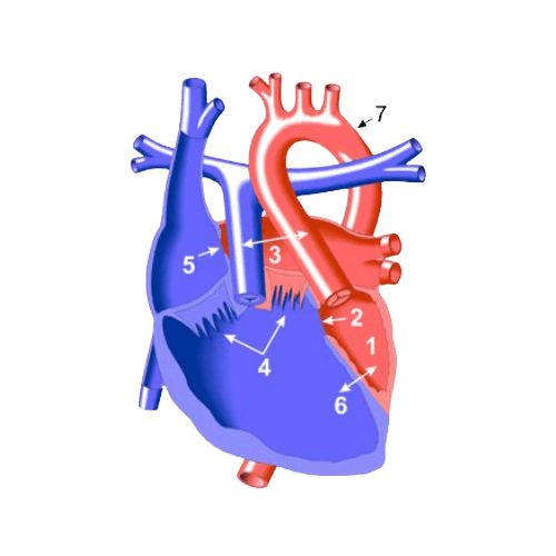 Ikki tomonlama kirish qismiga ega chap qorincha (Double Inlet Left Ventricle - DILV)