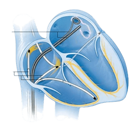 Electrophysiological Study (EPS)