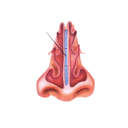 Endoscopic Septoplasty