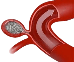 Endovaskulyar spiral qo‘yish