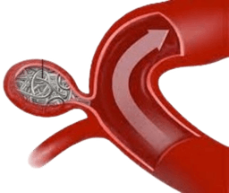 Endovaskulyar spiral qo‘yish