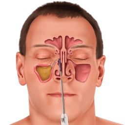 Ethmoidectomy