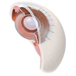 Extracapsular Cataract Extraction