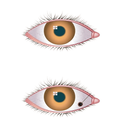 Eye Cancer