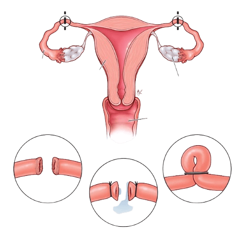 Ayollar sterilizatsiyasi – Tubektomiya