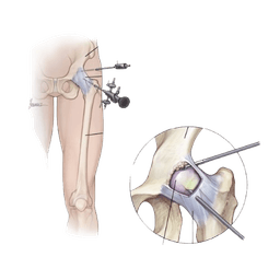 Femoroacetabular Impingement Surgery (FAI)