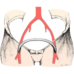 Femorofemoral Bypass