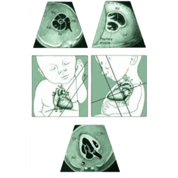 Fetal Echo