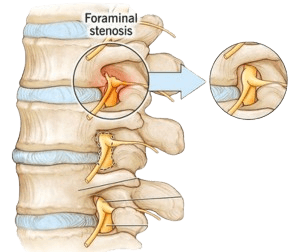 Foraminotomiya