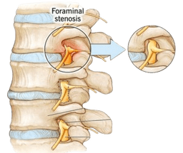 Foraminotomiya