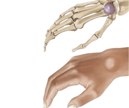 Ganglion kistasining olib tashlanishi