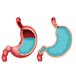 Gastroesophageal Reflux Disease