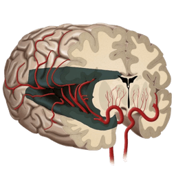 Hemispherectomy