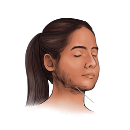 Hirsutism